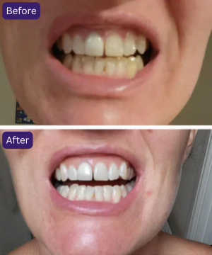Purple Teeth Whitening Strips